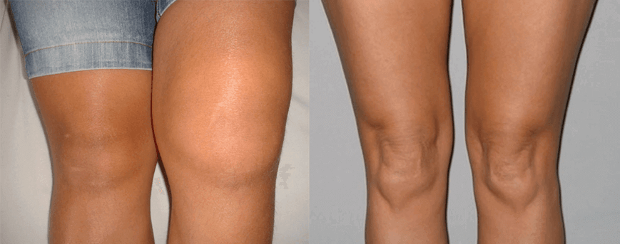 Patirtis naudojant kanapių aliejaus kapsules prieš ir po naudojimo iš Eva